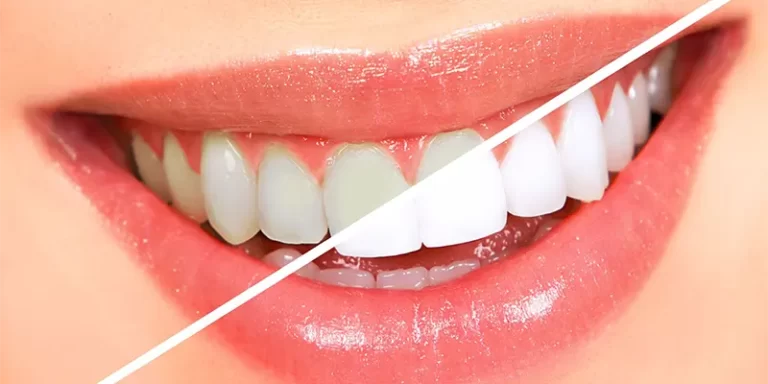 تبييض الاسنان ب 5 طرق ناجحة ومن المنزل