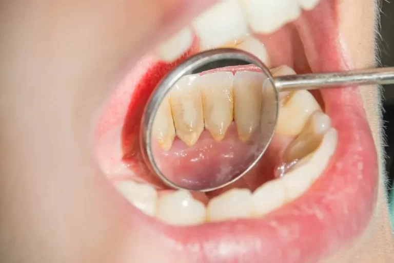 علاج اصفرار الأسنان نهائياً.. 8 طرق مجربة وفعالة من المنزل