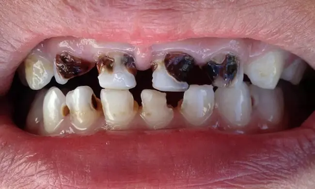 كيفية الوقاية من تسوس الأسنان.. 5 نصائح ذهبية تعرف عليها